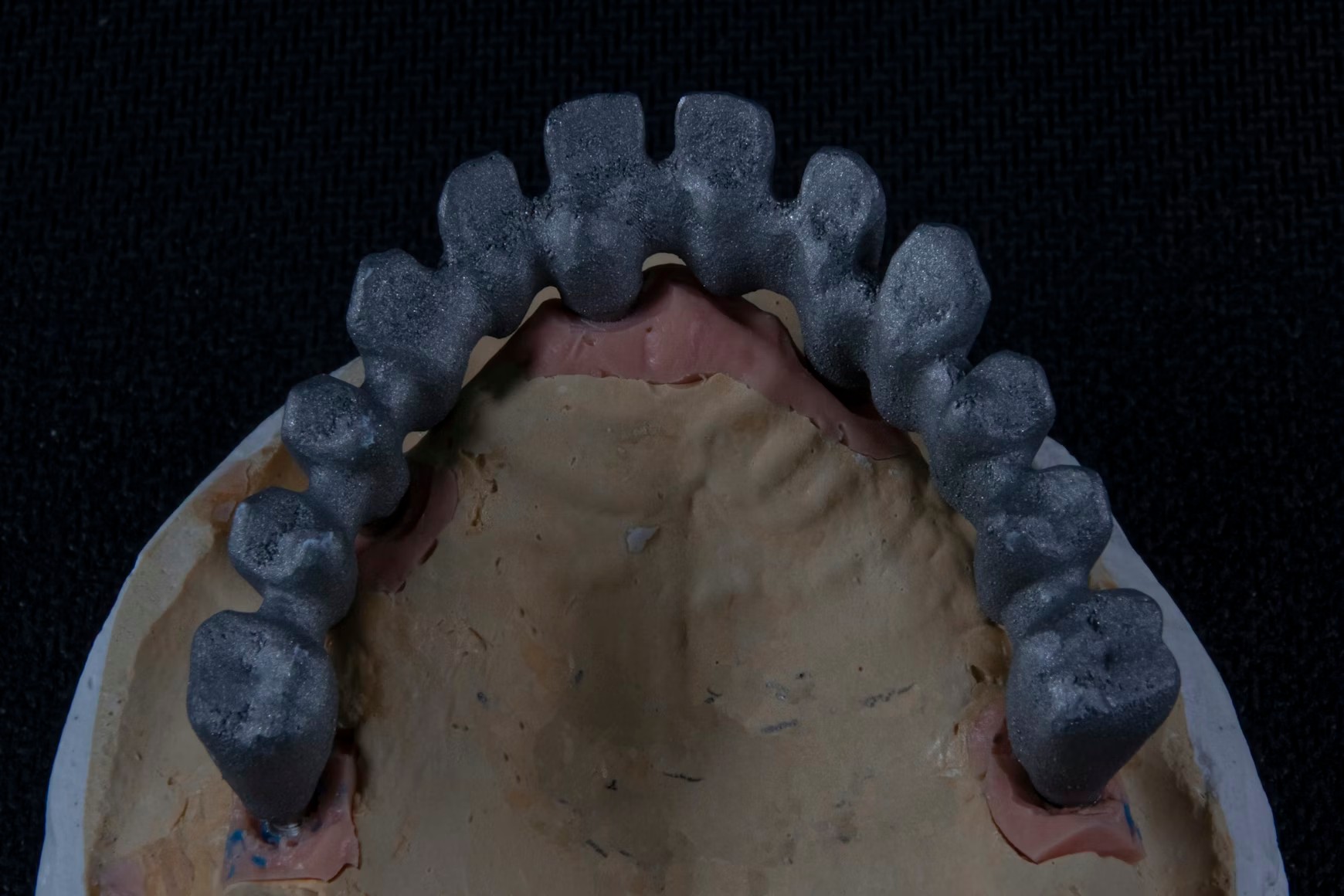 Resultado de restauración dental con coronas de porcelana