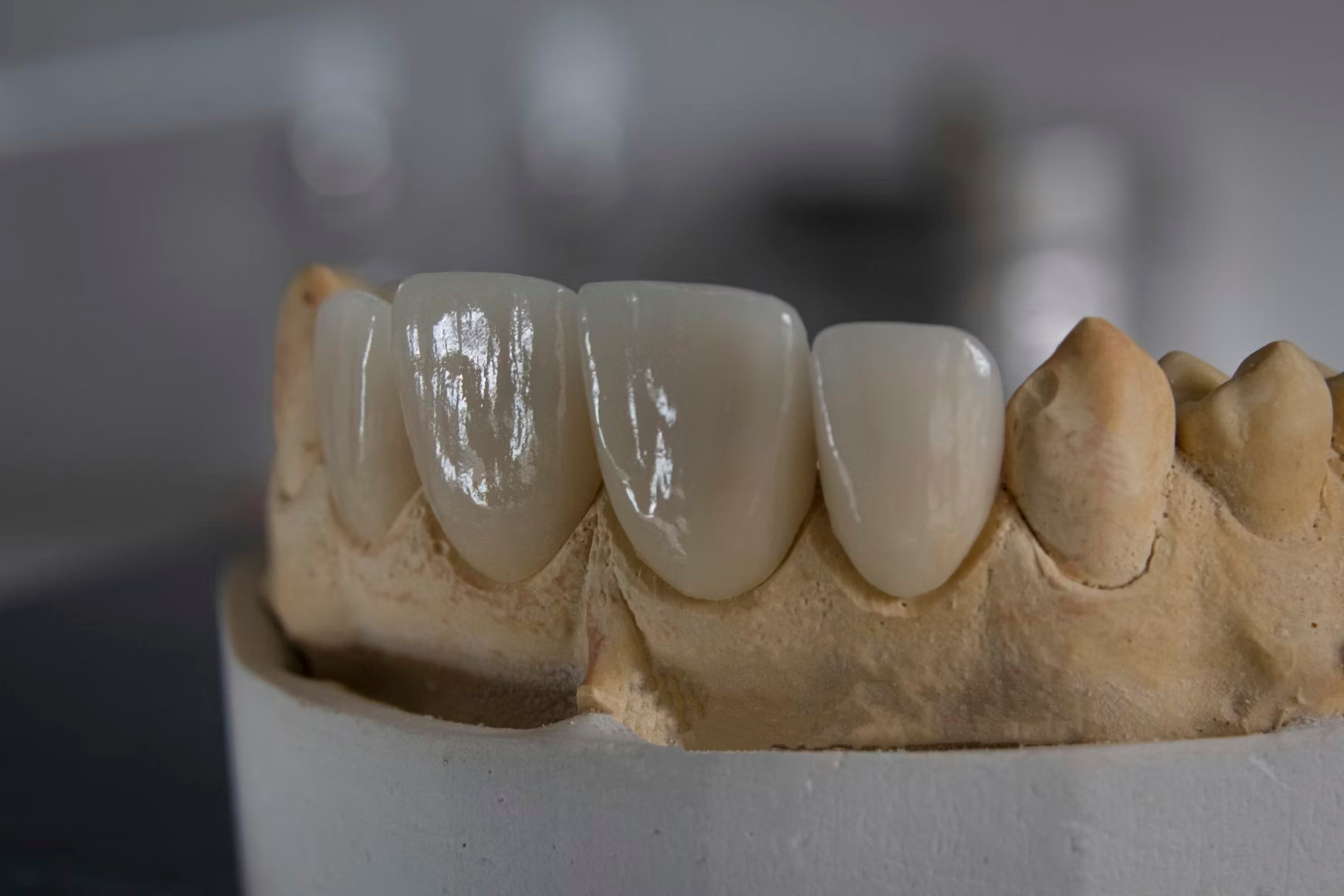 Resultado de blanqueamiento dental profesional en Dental Olympus