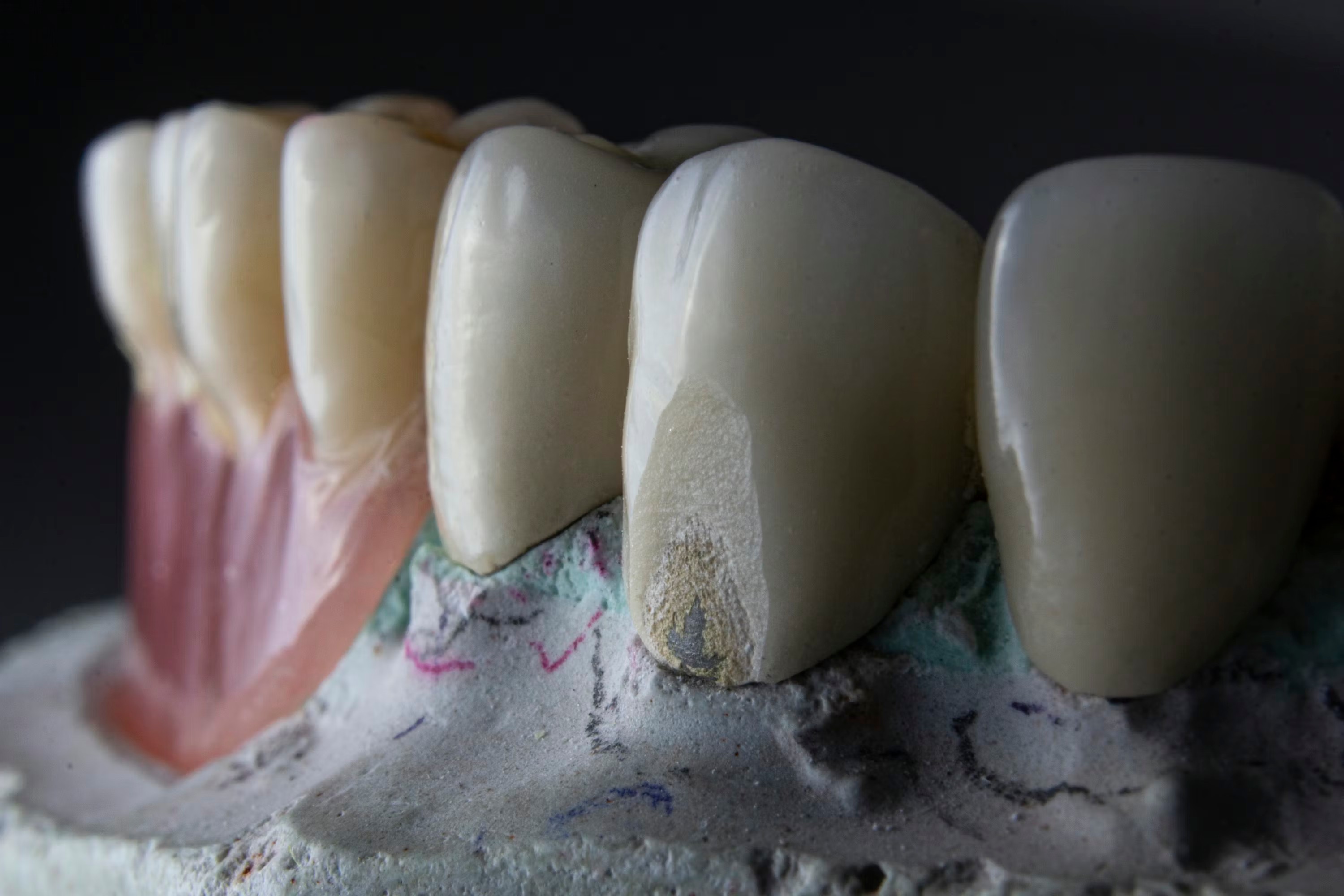Resultado de estética dental con carillas de porcelana